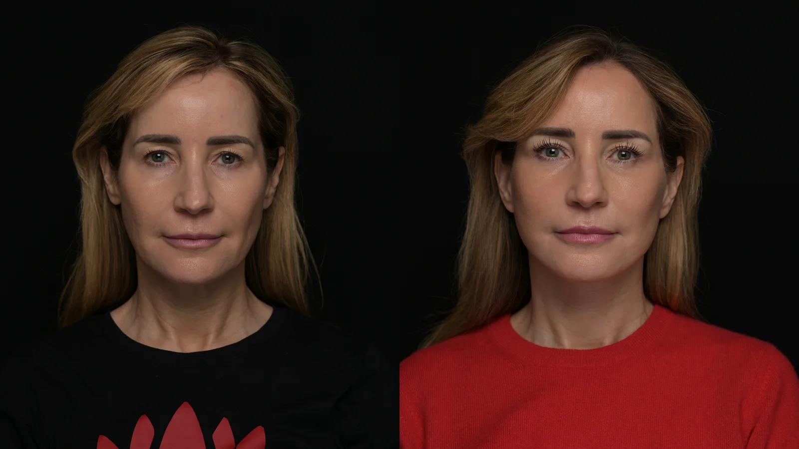 Photograph of a Revel You patient