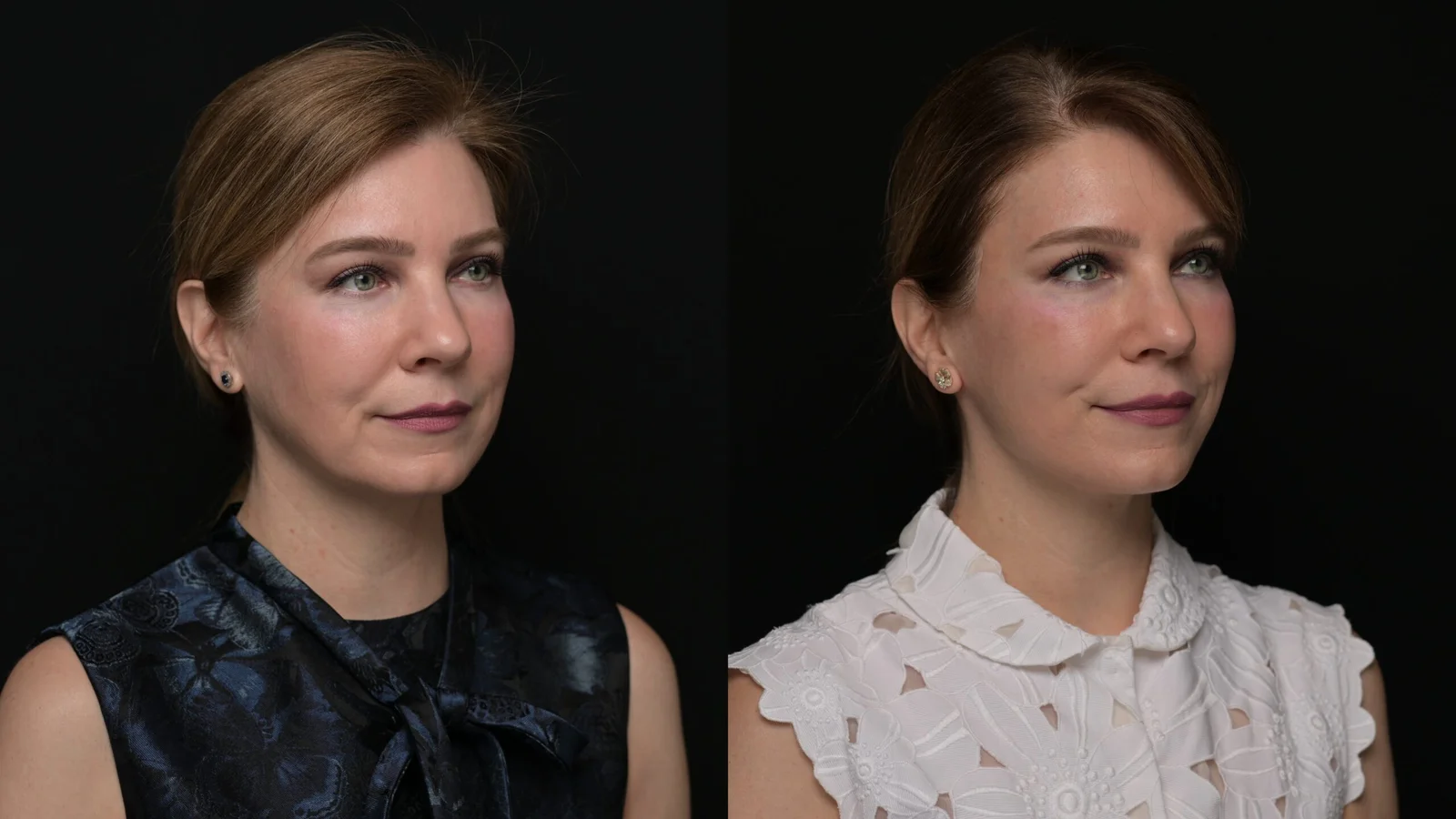 Before-and-after photograph, deep plane facelift and neck lift